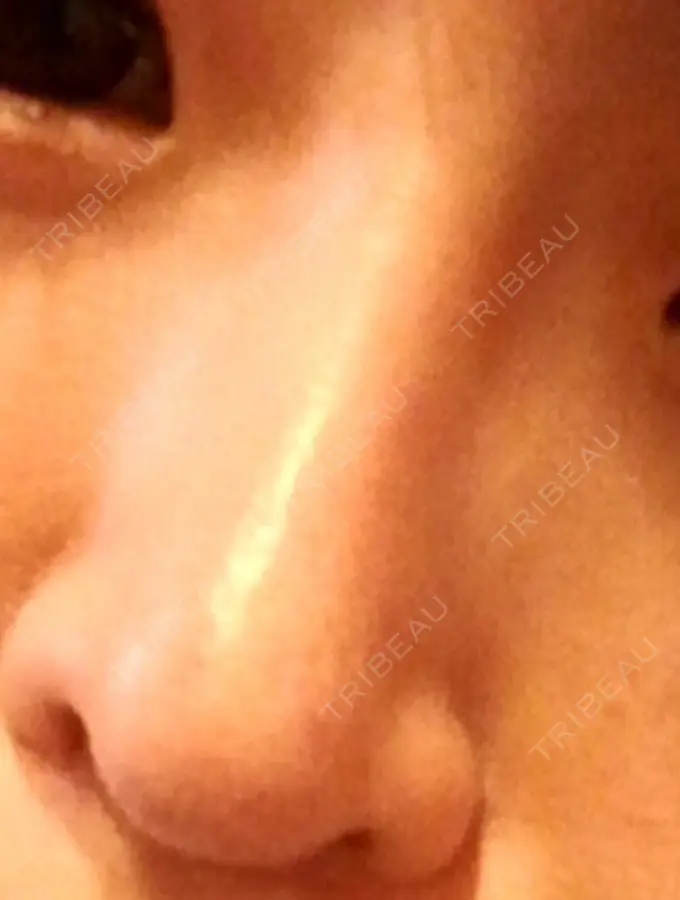 隆鼻術 / 鼻尖形成（切開） / 軟骨移植 ヤスミクリニック DAY 103 メイン用