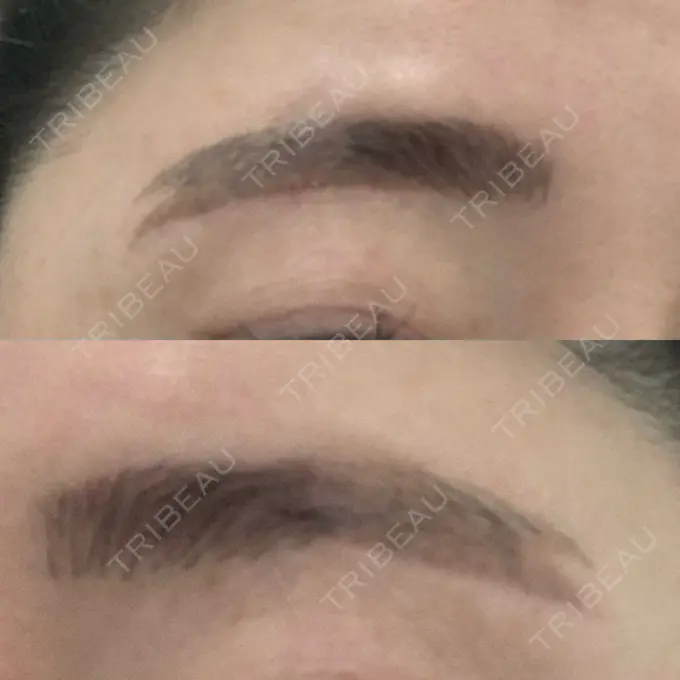 その他（目元） / その他 / 傷跡修正 名古屋中央クリニック DAY 9 メイン用