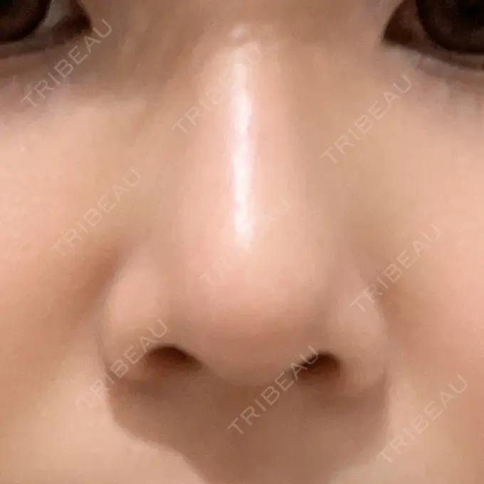 鼻尖形成（切開） / ヒアルロン酸注入（鼻） 東京ヒルズクリニック 岡崎院 AFTER メイン用