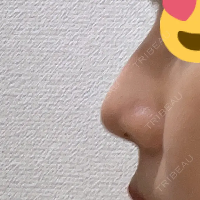 鼻尖形成（切開） / ヒアルロン酸注入（鼻） 東京ヒルズクリニック 岡崎院 DAY 12 メイン用