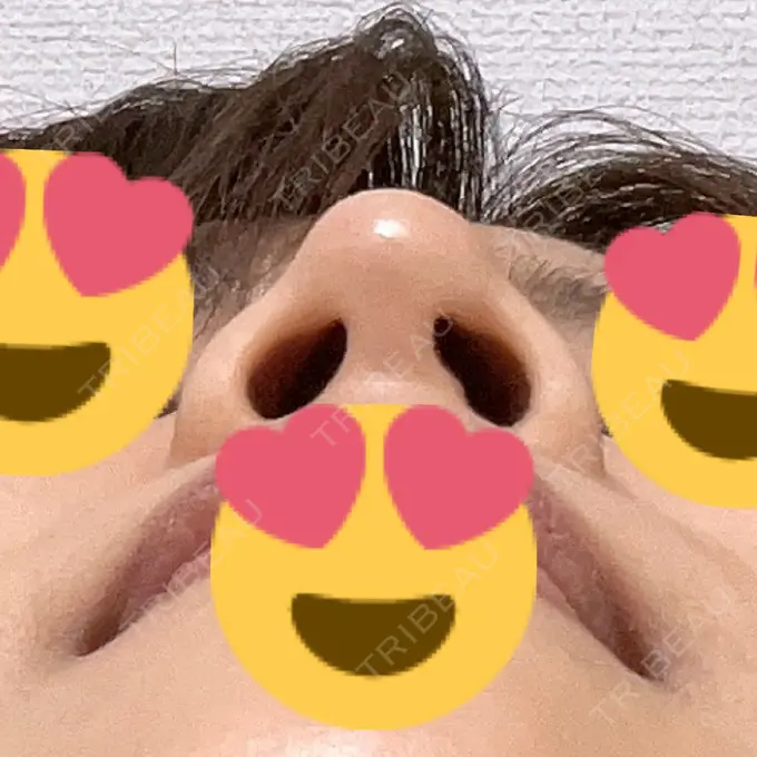 鼻尖形成（切開） / ヒアルロン酸注入（鼻） 東京ヒルズクリニック 岡崎院 DAY 12 メイン用