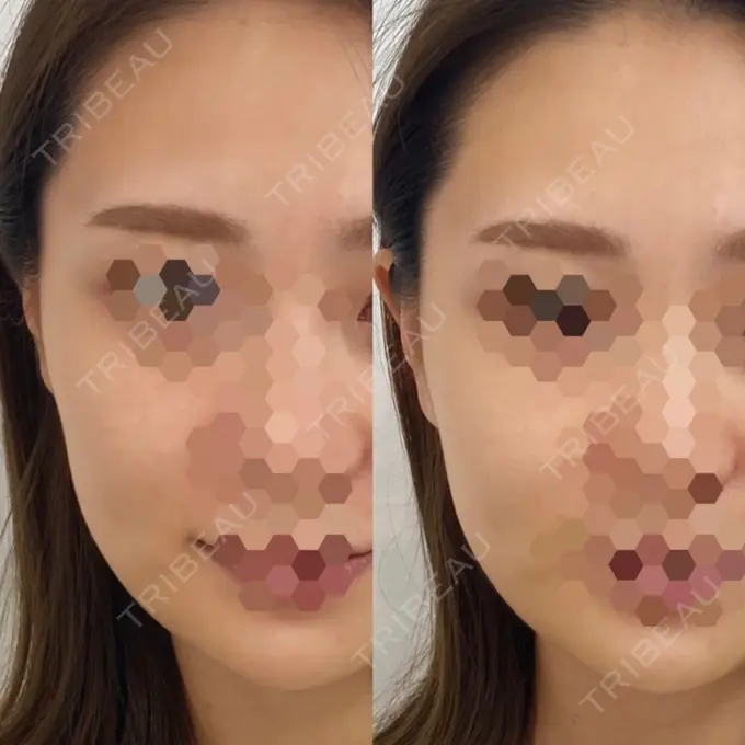 ハイフ（顔） STARS CLINIC DAY 0 メイン用