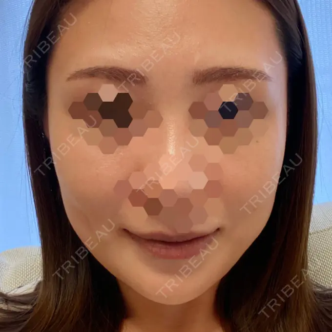 ハイフ（顔） STARS CLINIC AFTER メイン用