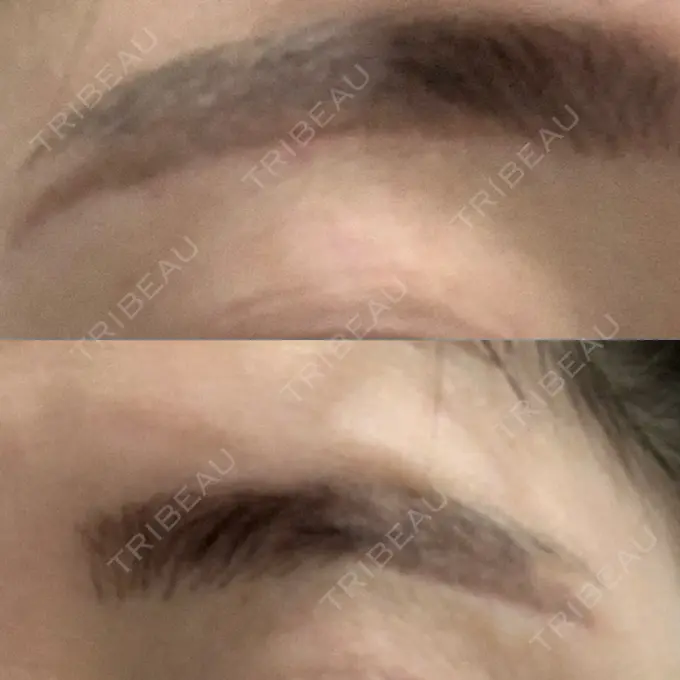 その他（目元） / その他 / 傷跡修正 名古屋中央クリニック DAY 10 メイン用