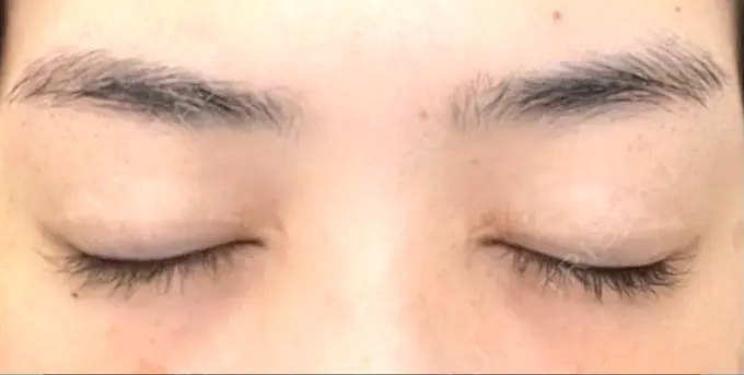 二重切開 / 目頭切開 城本クリニック 福岡院 DAY 693 メイン用