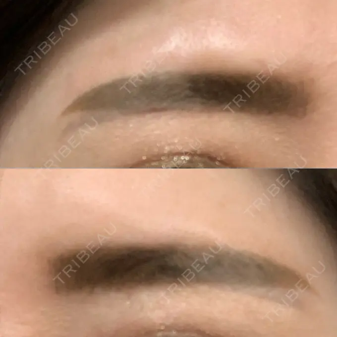 その他（目元） / その他 / 傷跡修正 名古屋中央クリニック DAY 11 メイン用