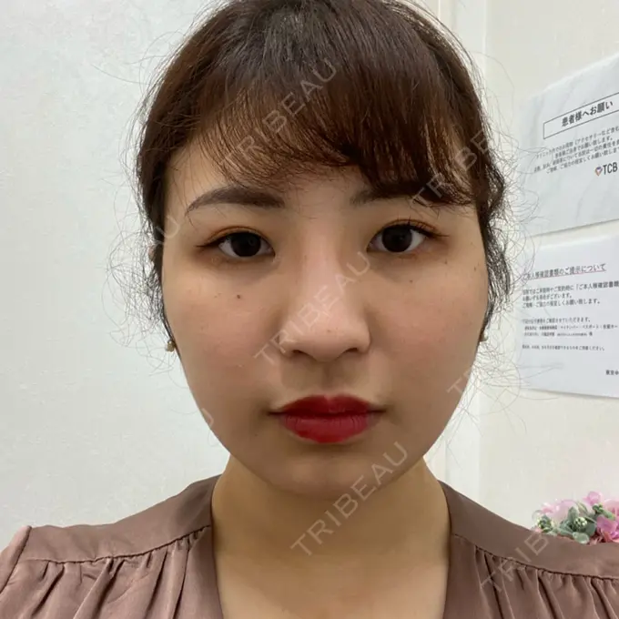 糸リフト / 脂肪吸引（顔） / その他（輪郭） TCB東京中央美容外科 八王子院 DAY 42 メイン用