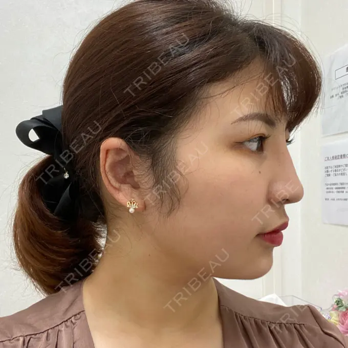 糸リフト / 脂肪吸引（顔） / その他（輪郭） TCB東京中央美容外科 八王子院 DAY 42 メイン用