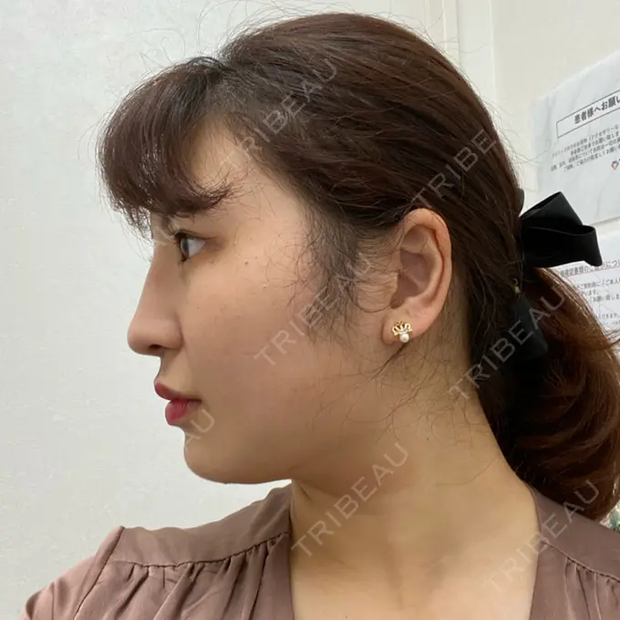 糸リフト / 脂肪吸引（顔） / その他（輪郭） TCB東京中央美容外科 八王子院 DAY 42 メイン用