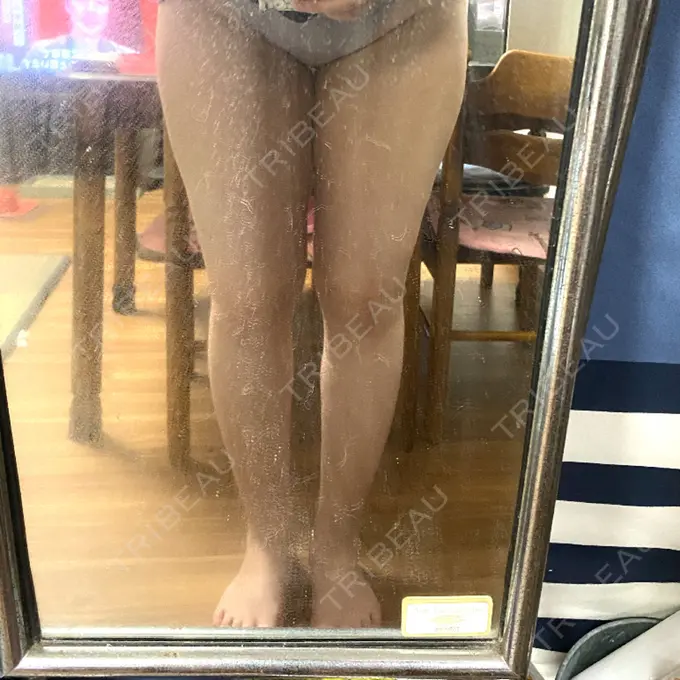 脂肪吸引（脚） THE CLINIC（ザ・クリニック） 名古屋院 DAY 16 メイン用