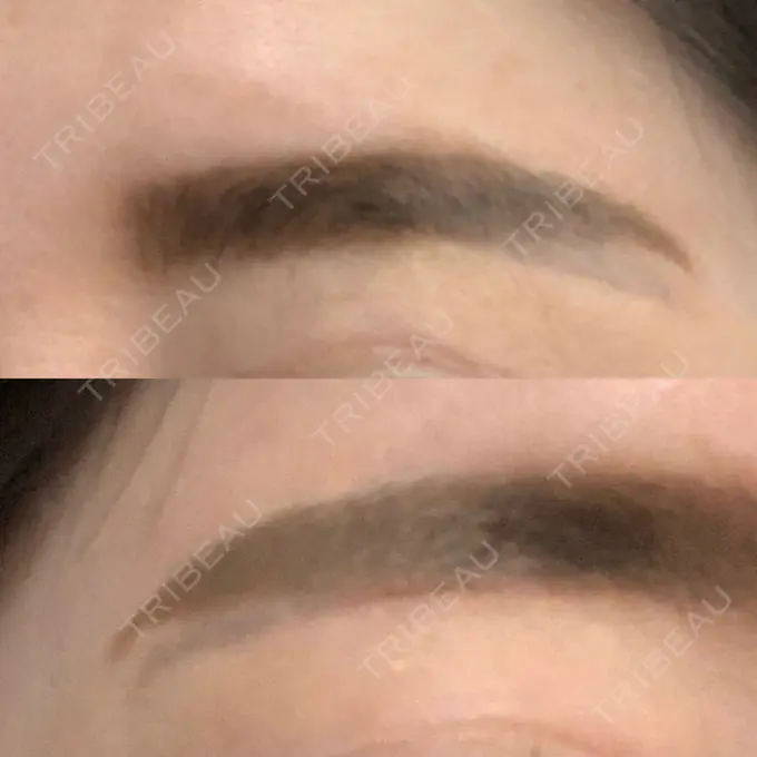 その他（目元） / その他 / 傷跡修正 名古屋中央クリニック AFTER メイン用