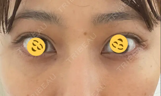 二重埋没 / クマ治療 / 上まぶたたるみ取り / 下まぶたたるみ取り MIL CLINIC OSAKA AFTER メイン用