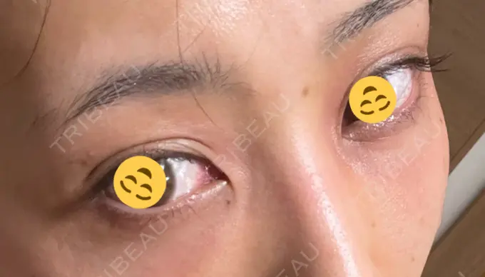 二重埋没 / クマ治療 / 上まぶたたるみ取り / 下まぶたたるみ取り MIL CLINIC OSAKA DAY 23 メイン用