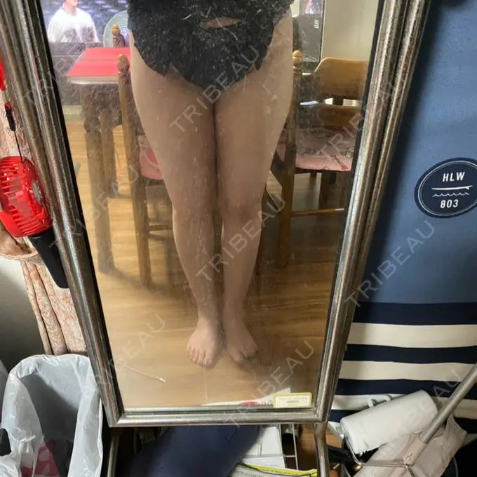 脂肪吸引（脚） THE CLINIC（ザ・クリニック） 名古屋院 DAY 19 メイン用