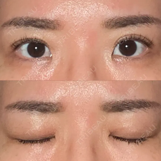 二重埋没 東京BELLEZZAクリニック DAY 89 メイン用