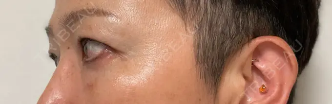 クマ治療 / 下まぶたたるみ取り セオリークリニック DAY 10 メイン用