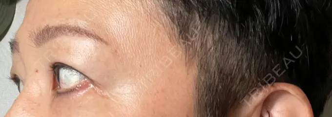 クマ治療 / 下まぶたたるみ取り セオリークリニック DAY 11 メイン用