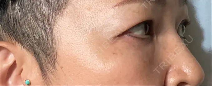 クマ治療 / 下まぶたたるみ取り セオリークリニック DAY 11 メイン用