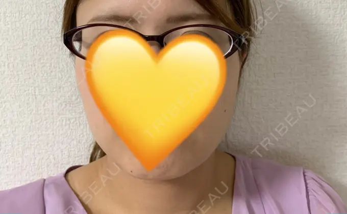 ボトックス（あご） / ボトックス（エラ・小顔） 湘南美容クリニック 名古屋栄院 AFTER メイン用