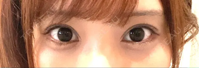 眉下切開 湘南美容クリニック 高田馬場院 AFTER メイン用