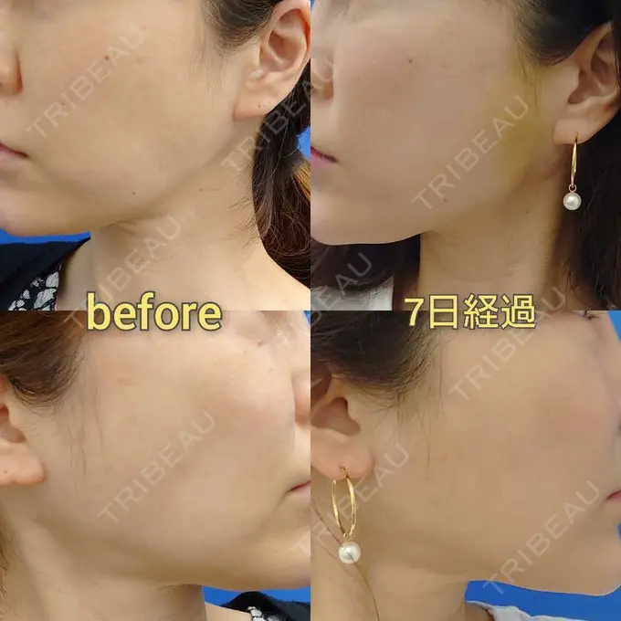 糸リフト MIL CLINIC OSAKA DAY 8 メイン用