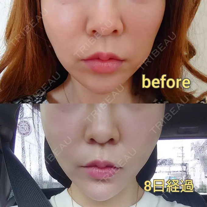 糸リフト MIL CLINIC OSAKA DAY 8 メイン用