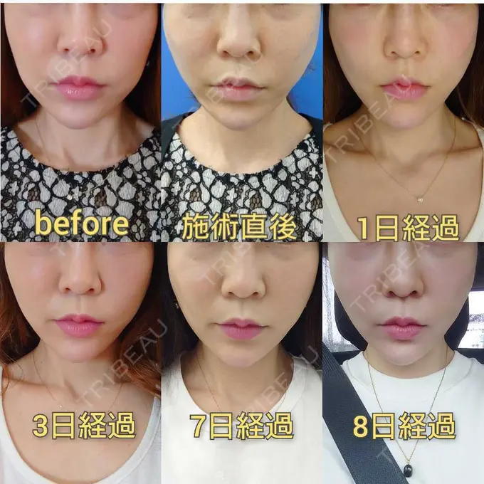 糸リフト MIL CLINIC OSAKA DAY 8 メイン用