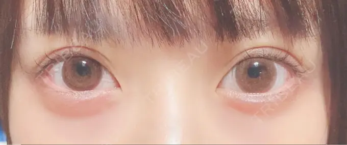 ヒアルロン酸注入（涙袋） 湘南美容クリニック 大阪あべの院 DAY 164 メイン用