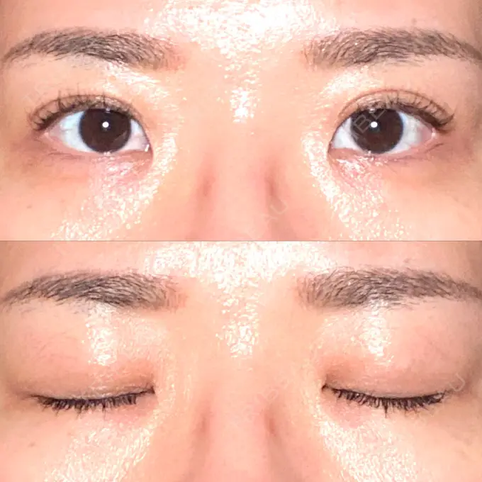 二重埋没 東京BELLEZZAクリニック DAY 92 メイン用