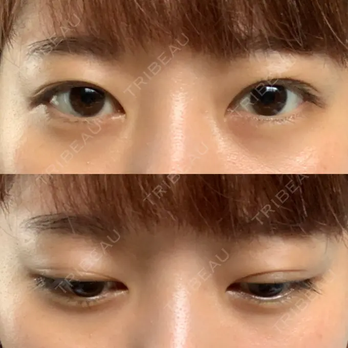 二重埋没 船橋中央クリニック DAY 63 メイン用