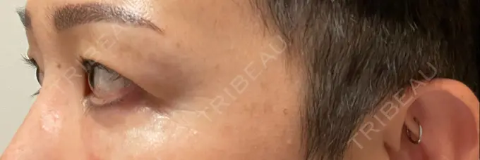 クマ治療 / 下まぶたたるみ取り セオリークリニック DAY 13 メイン用