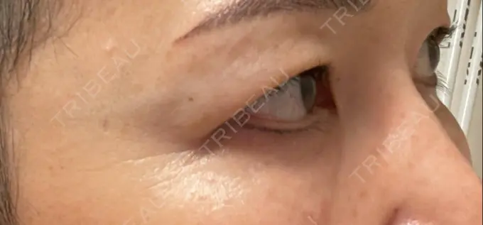 クマ治療 / 下まぶたたるみ取り セオリークリニック DAY 13 メイン用