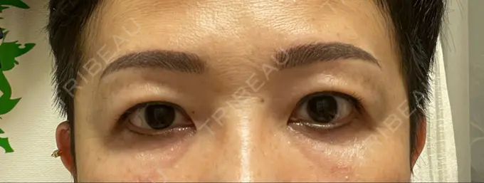 クマ治療 / 下まぶたたるみ取り セオリークリニック DAY 13 メイン用