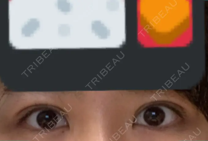 二重埋没 ハナビューティークリニック DAY 19 メイン用