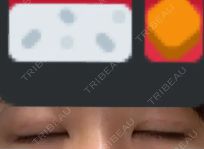 二重埋没 ハナビューティークリニック DAY 19 メイン用