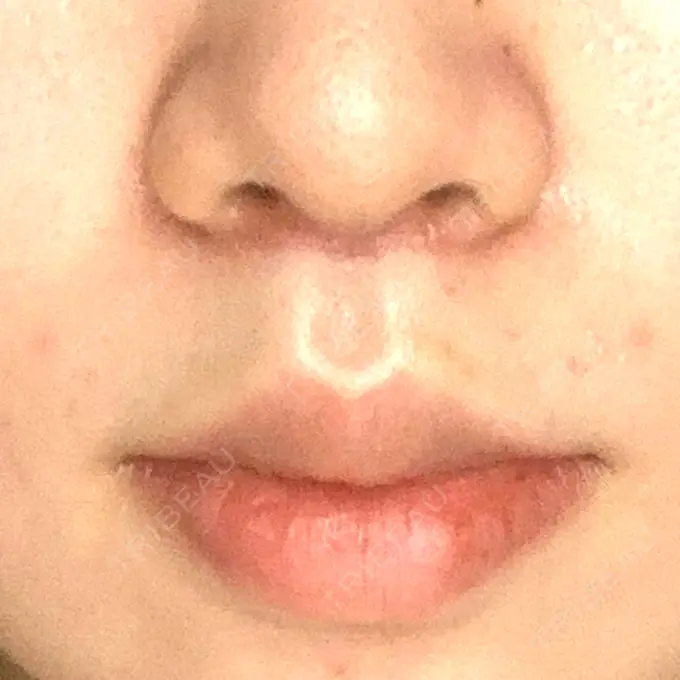 人中短縮 / ボトックス（口角） 新宿ラクル美容外科クリニック 新宿院 DAY 16 メイン用