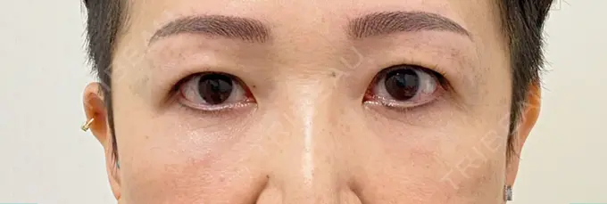 クマ治療 / 下まぶたたるみ取り セオリークリニック AFTER メイン用