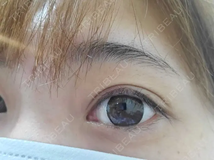 二重埋没 湘南美容クリニック 橋本院 DAY 100 メイン用