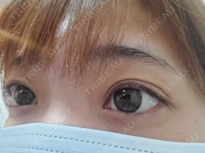 二重埋没 湘南美容クリニック 橋本院 AFTER メイン用