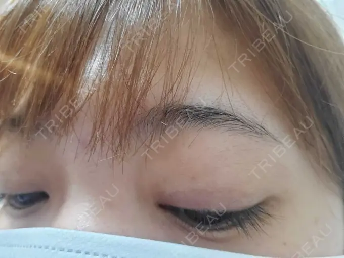 二重埋没 湘南美容クリニック 橋本院 DAY 100 メイン用