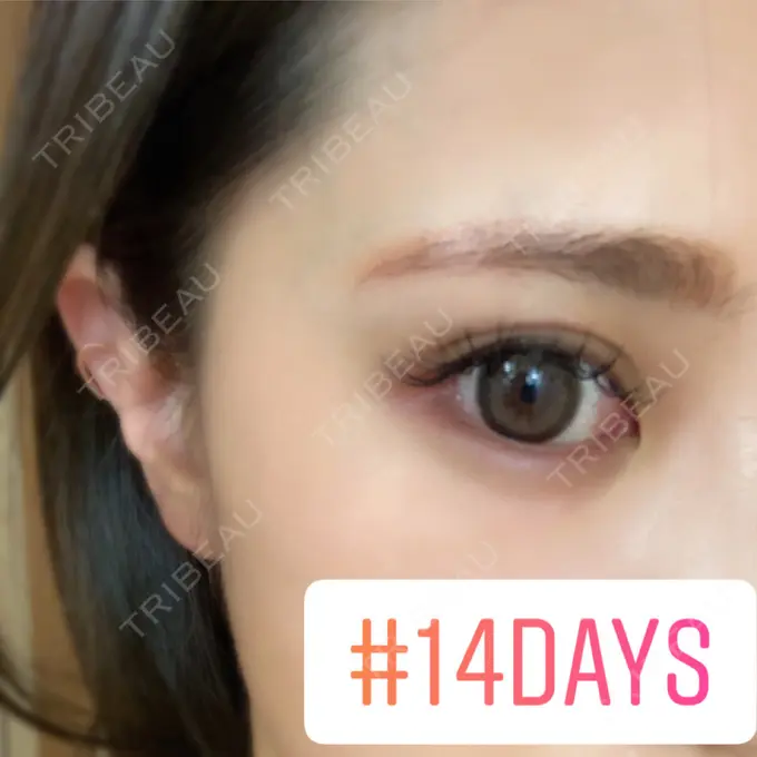 アートメイク（眉） 筋肉・美容クリニック DAY 13 メイン用