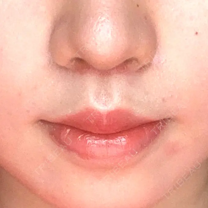 人中短縮 / ボトックス（口角） 新宿ラクル美容外科クリニック 新宿院 DAY 19 メイン用