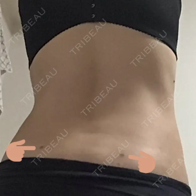 脂肪吸引（お腹） / その他（ボディ） THE CLINIC（ザ・クリニック） 福岡院 DAY 193 メイン用