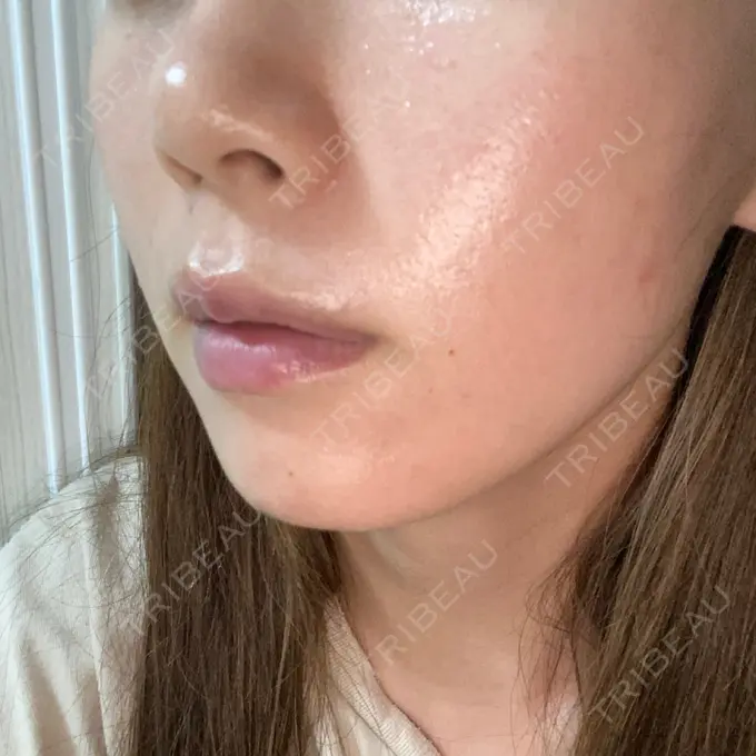 毛穴洗浄（ハイドラフェイシャルなど） X CLINIC 恵比寿院 DAY 0 メイン用