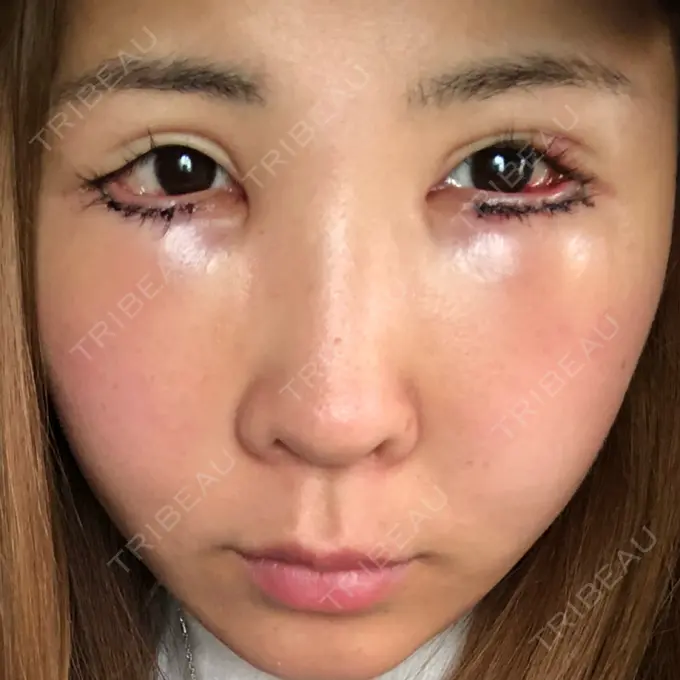 目尻切開 / タレ目形成・グラマラスライン（切開） 品川美容外科 横浜院（※品川スキンクリニック提携） DAY 1 メイン用