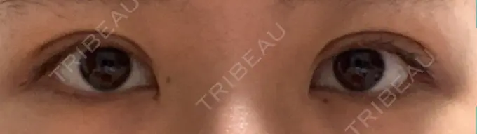 二重埋没 ハナビューティークリニック DAY 23 メイン用