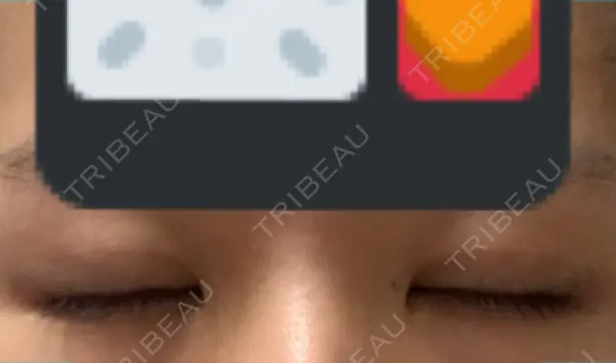 二重埋没 ハナビューティークリニック DAY 23 メイン用