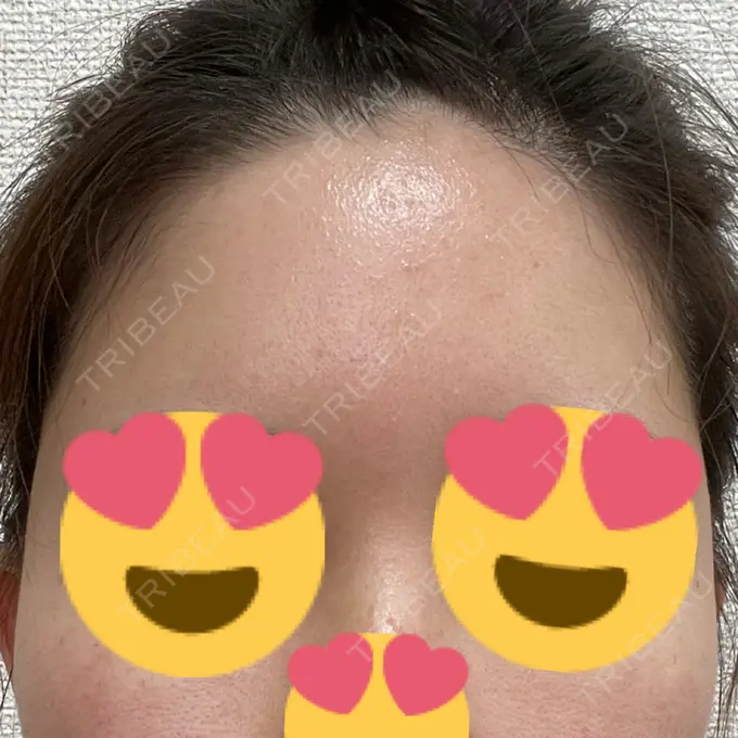 脂肪注入（額） / 脂肪注入（輪郭） 牧野美容クリニック DAY 12 メイン用