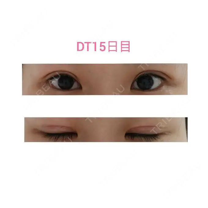 二重切開 / 眼瞼下垂（切開） 城本クリニック 福岡院 DAY 15 メイン用