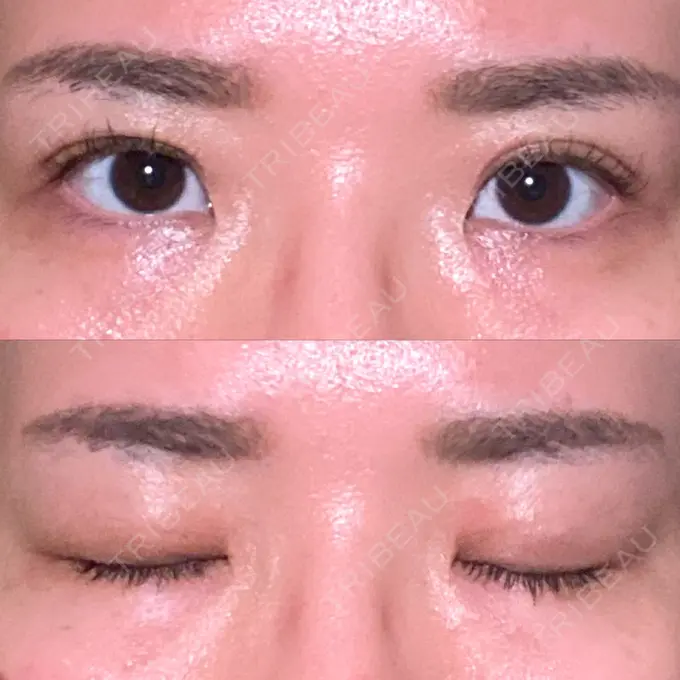 二重埋没 東京BELLEZZAクリニック DAY 99 メイン用